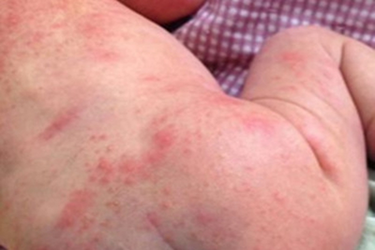 新生儿毒性红斑出现红斑图