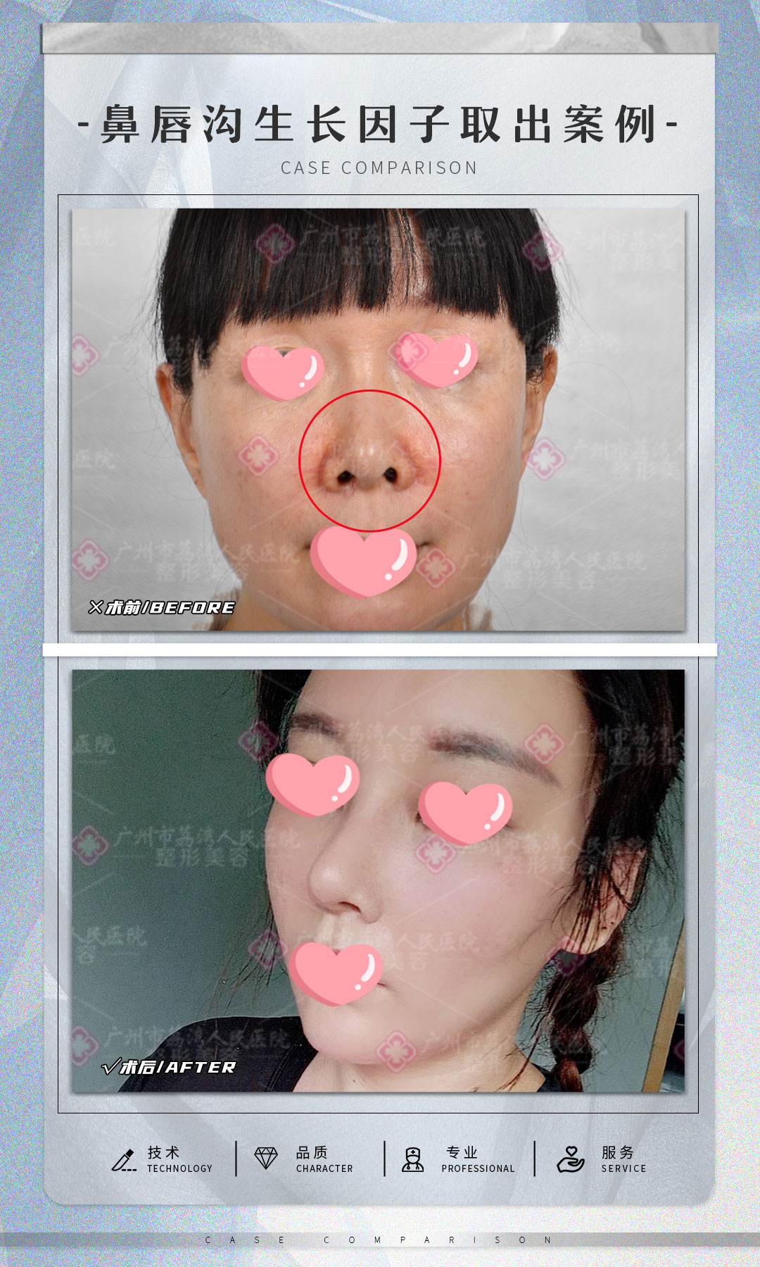 医美隆鼻整形对比海报PSD广告设计素材海报模板免费下载-享设计