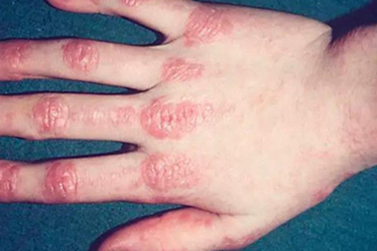 皮肌炎手背症状图