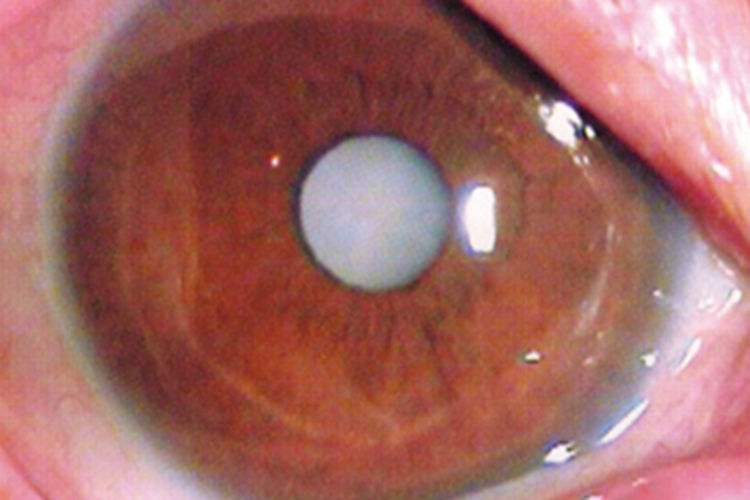 皮质性白内障瞳孔变白图