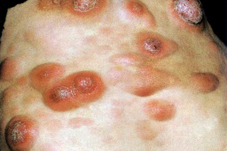 皮肤白血病背部水疱图