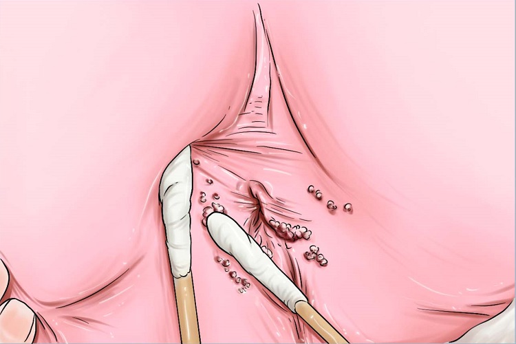 尖锐湿疣早期手绘图