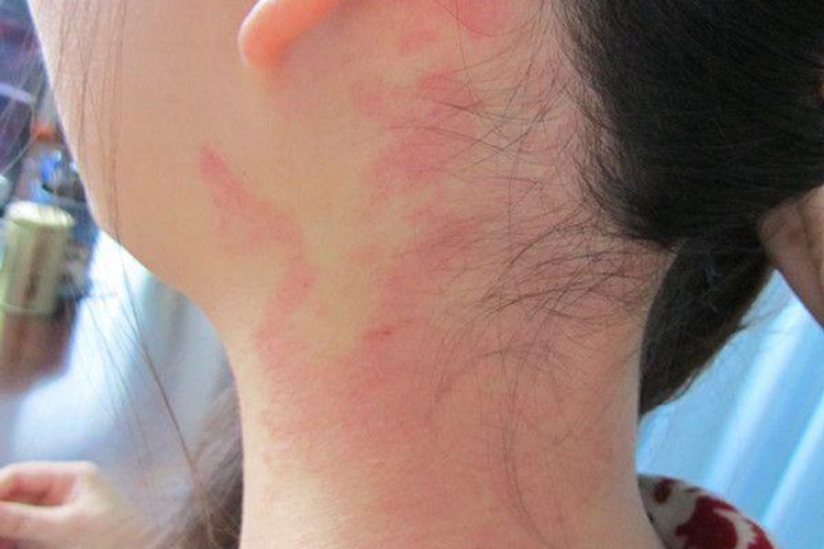 耳后鲜红斑痣图
