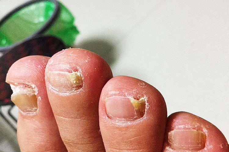 脚远端侧位甲下型甲真菌病图