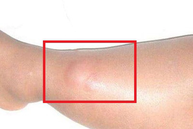 滑膜肉瘤小腿症状图