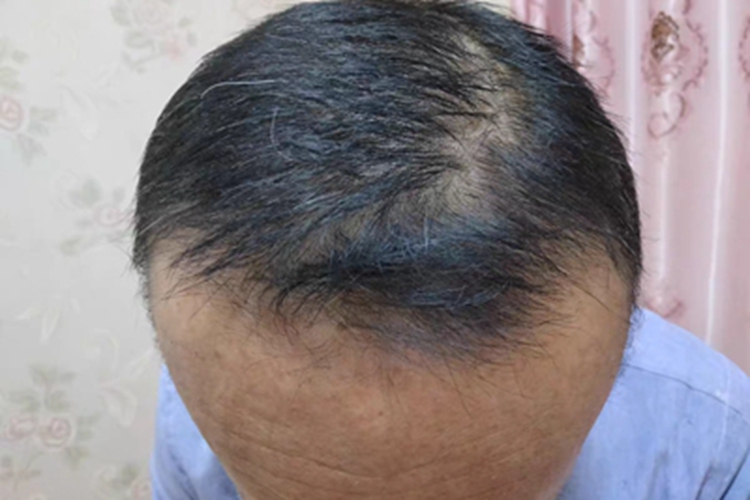 雄激素性脱发头上掉发图 雄激素性脱发头上掉发图
