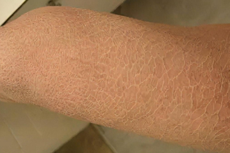 获得性鱼鳞病大腿症状图