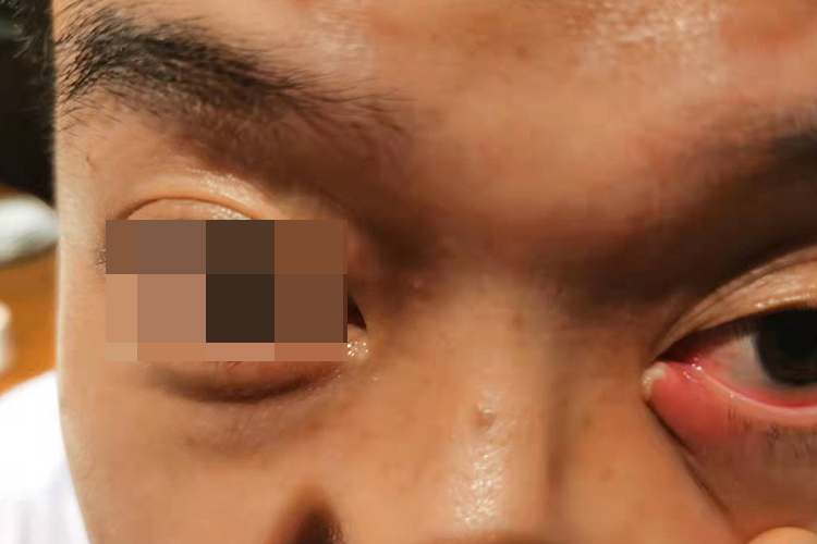 眼角处外睑腺炎图