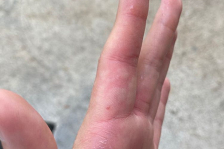 蜂蜇伤手指水肿图