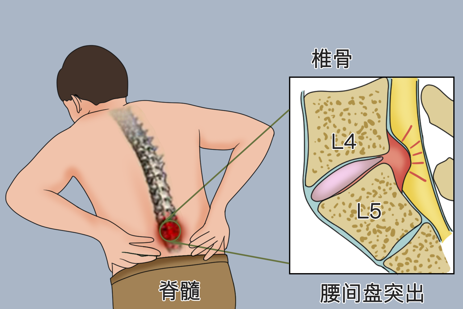 腰间盘突出症疼痛位置图