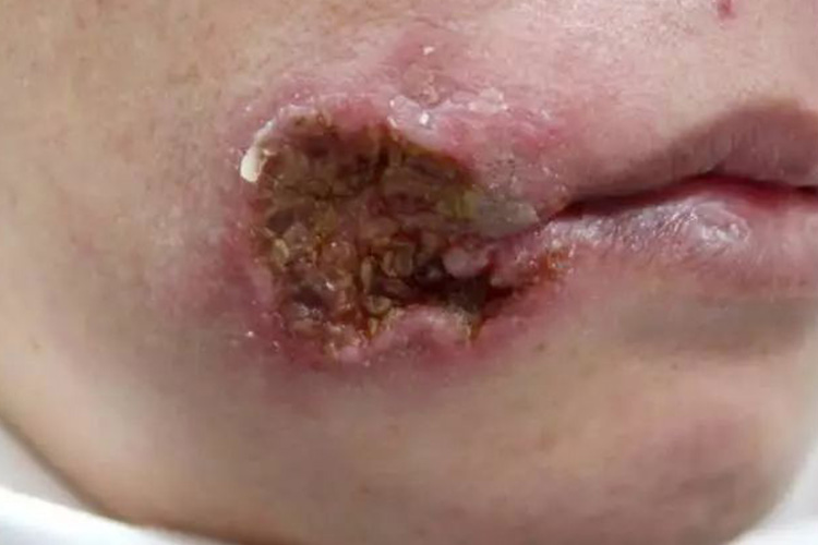 女性梅毒性树胶肿图