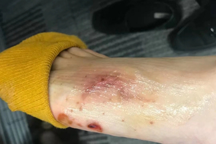 一度烫伤脚背红斑图 一度烫伤脚背红斑图