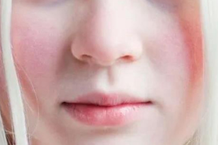 眼皮肤白化病症状图