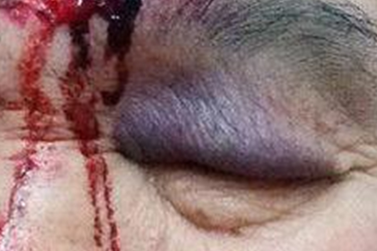 颅底出血熊猫眼图 颅底出血熊猫眼图