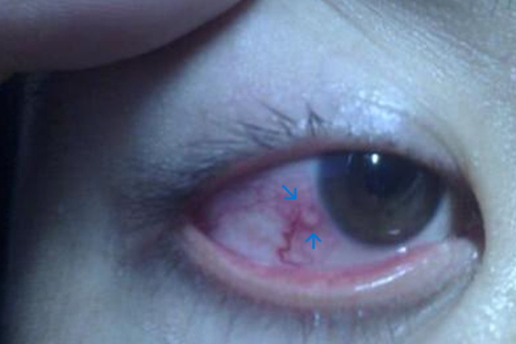 泡性结膜炎眼球疙瘩图