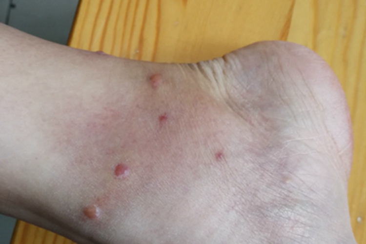 蚋叮咬引起的皮肤反应脚踝红斑图 蚋叮咬引起的皮肤反应脚踝红斑图