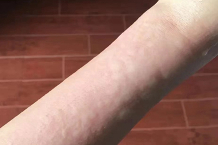 荨麻疹胳膊凹凸不平图