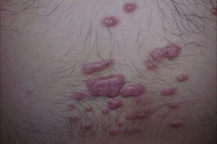 增生性瘢痕胸部多个疙瘩图 增生性瘢痕胸部多个疙瘩图