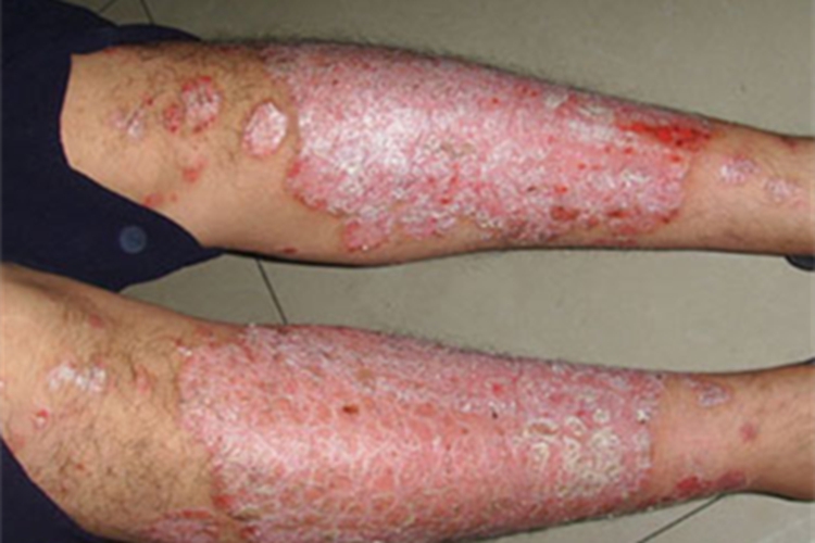 苔藓状淀粉样变小腿红斑图