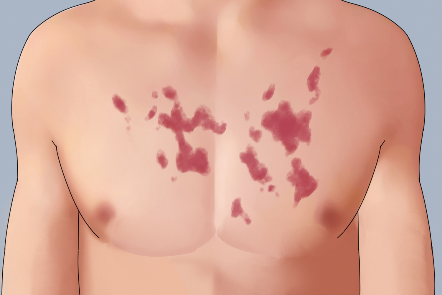 胸口过敏性紫癜图