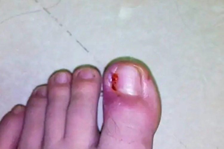 嵌甲大脚趾甲边缘流鲜血图