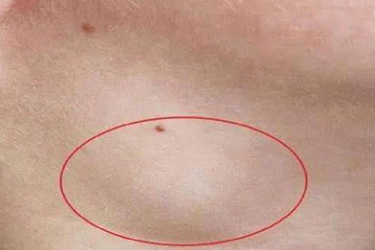 艾滋病期侧颈症状图