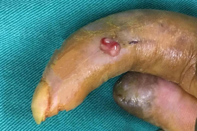 脓性指头炎形成慢性骨髓炎图