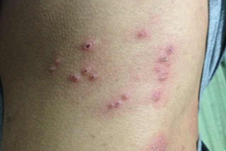 体虱病腰部丘疹图