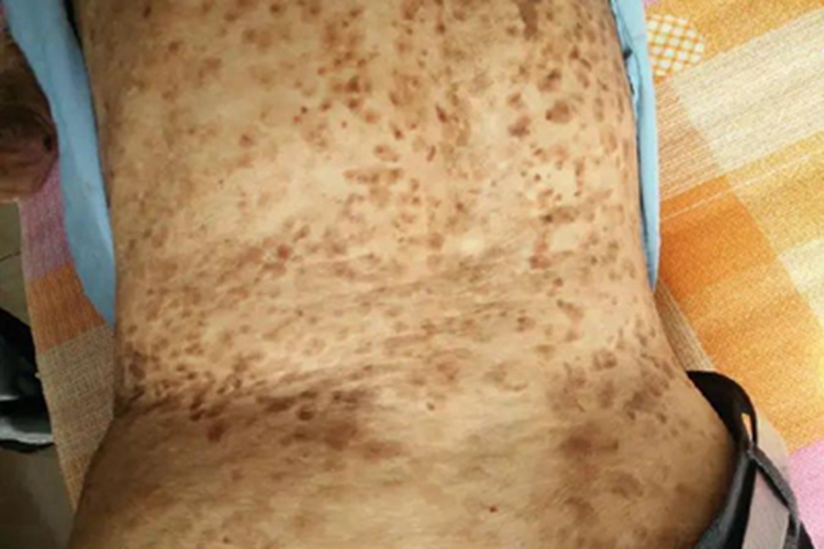 疣状表皮发育不良背部褐色疙瘩图