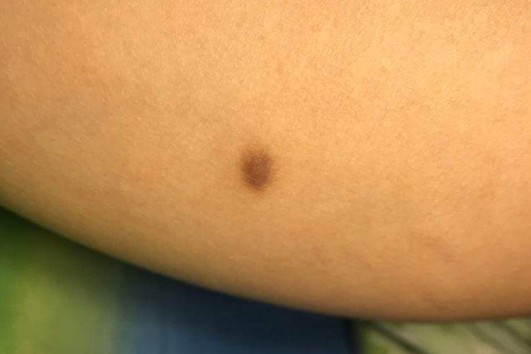 屁股上的色素痣图 屁股上的色素痣图