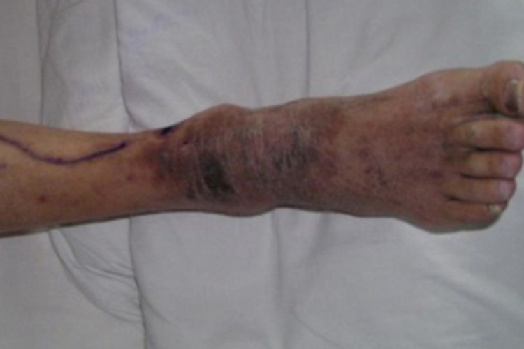 游走性血栓性浅静脉炎脚踝症状图