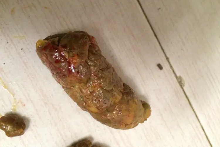 儿童血热大便带血图 儿童血热大便带血图