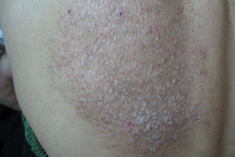 皮肤淀粉样变背部症状图