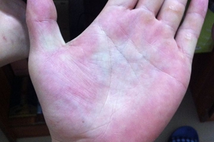 肝掌手掌大面积发红图