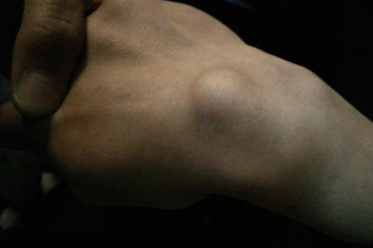 手背脂肪瘤图 手背脂肪瘤图