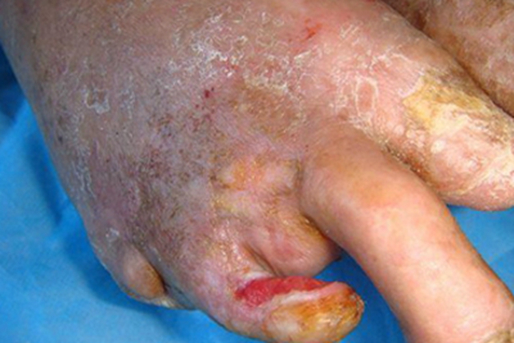血栓闭塞性脉管炎脚部脱屑图 血栓闭塞性脉管炎脚部脱屑图