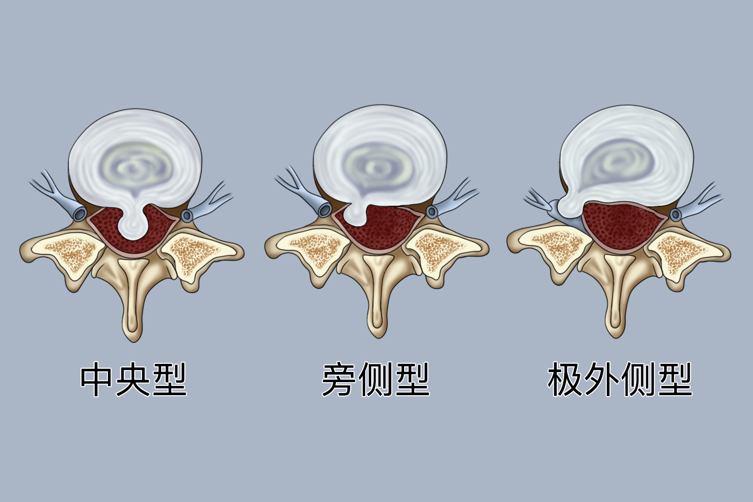 椎间盘突出中央型横切面图