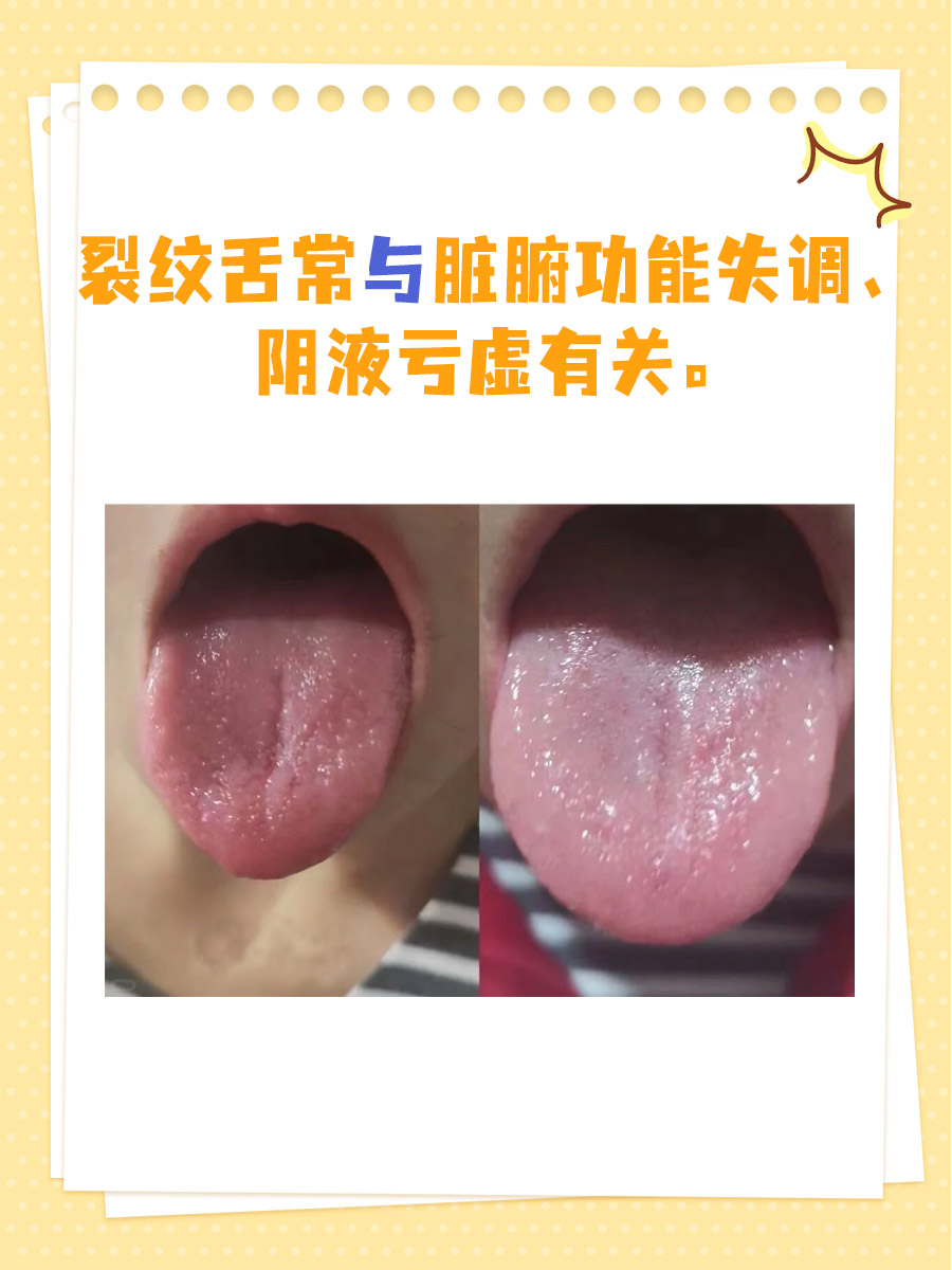 裂纹舌,中医上一般怎么辨证治疗?