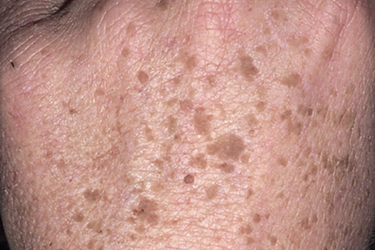 疣状脂溢性角化症手背症状图 疣状脂溢性角化症手背症状图