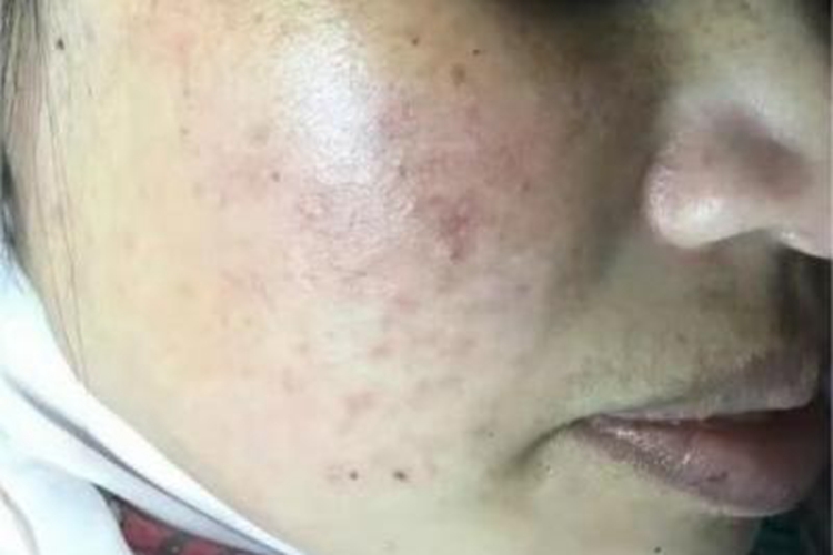 面部皮炎皮肤颜色加深图 面部皮炎皮肤颜色加深图