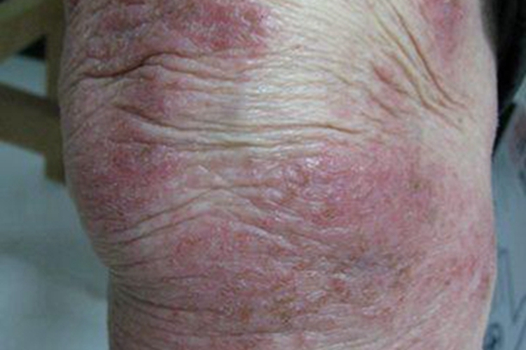 苔藓样淀粉样变病膝盖红斑图