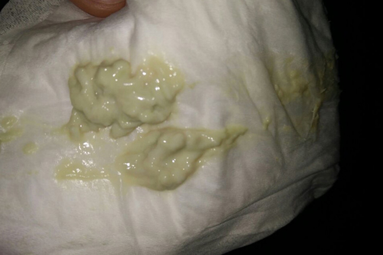 凝乳状白色分泌物图