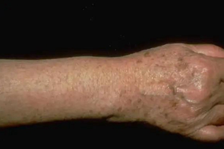 日光性雀斑样痣手背长斑图 日光性雀斑样痣手背长斑图