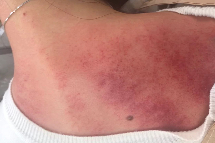 背部按摩后出现淤紫图