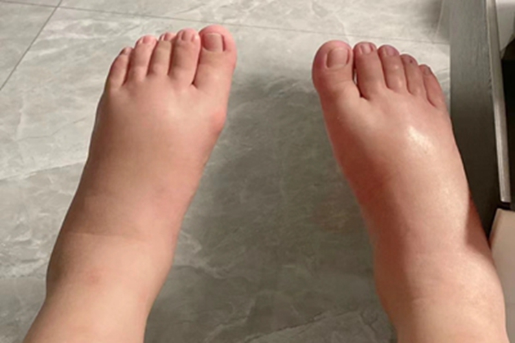 蛋白质营养不良脚部水肿图 蛋白质营养不良脚部水肿图