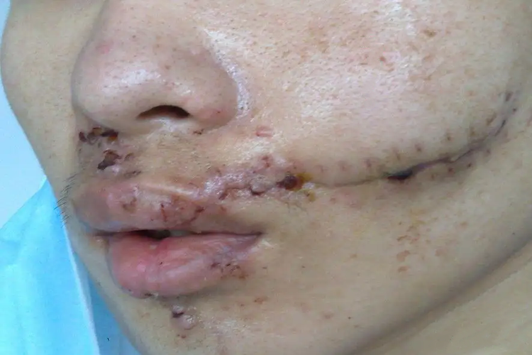 外伤导致面部塌陷图 外伤导致面部塌陷图