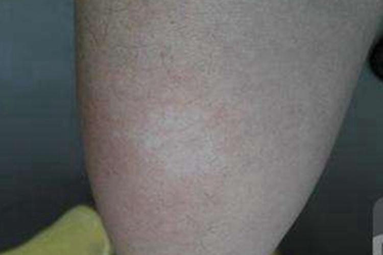 白癜风大腿症状图