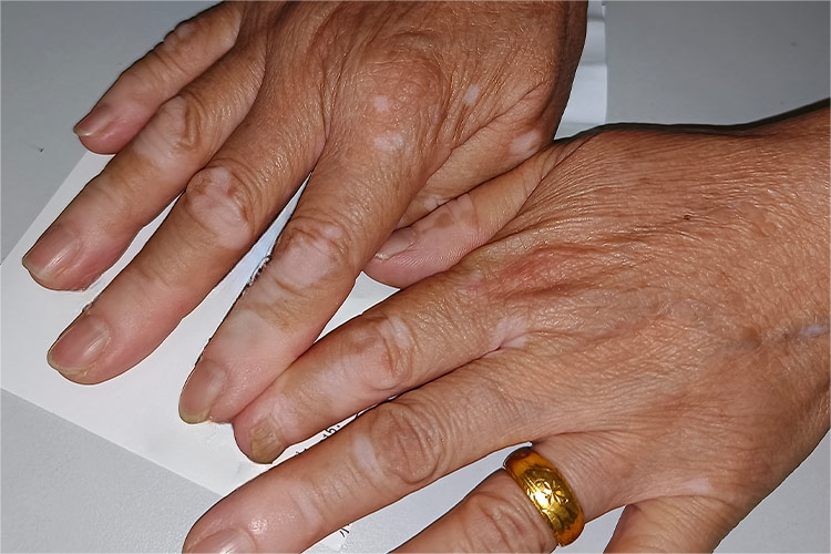 白癜风早期症状图 白癜风早期症状图