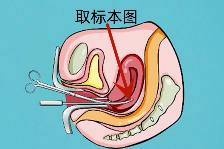 诊断性刮宫图 诊断性刮宫图