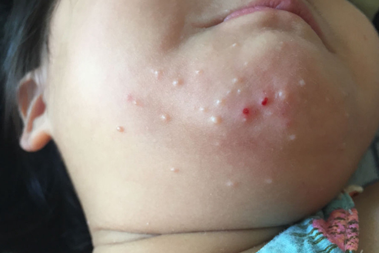 儿童螨虫皮炎图